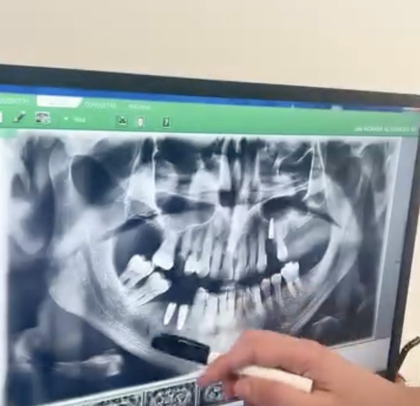 Diagnóstico con radiografía panorámica en DUELINE Alicante